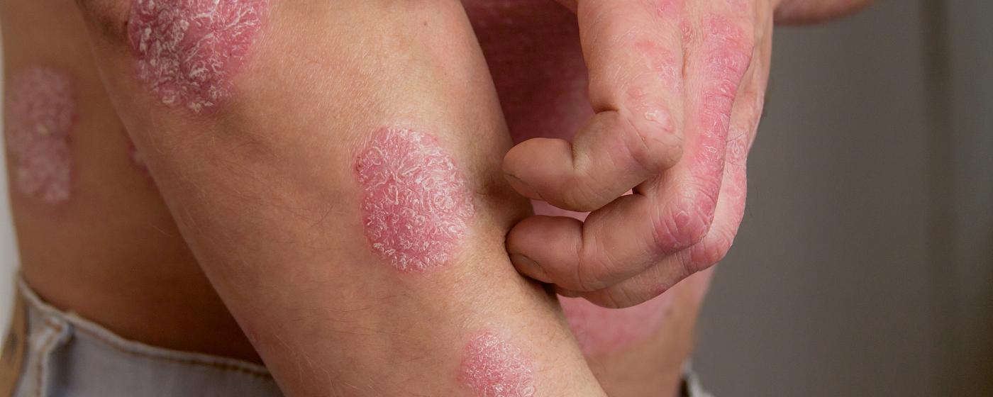 Psoriasis